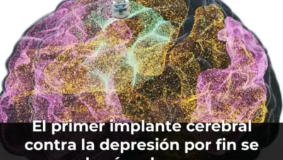 El primer implante cerebral contra la depresión por fin se probará en humanos