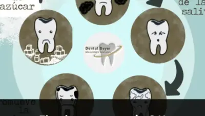¿El azúcar causa caries? No exactamente