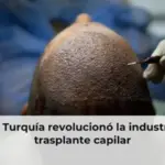 Cómo Turquía revolucionó la industria del trasplante capilar